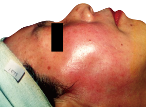 赤ら顔改善例1:Before