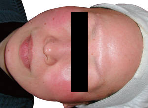 赤ら顔改善例2:Before