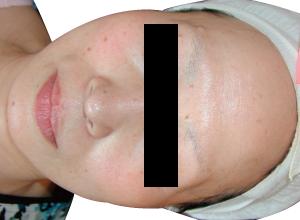 赤ら顔改善例2:After