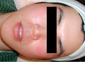 赤ら顔改善例3:After