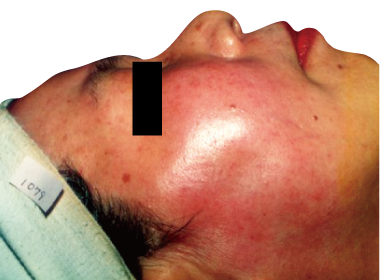 赤ら顔改善例1:Before