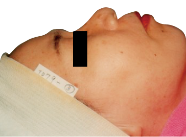 赤ら顔改善例1:After