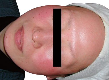 赤ら顔改善例2:Before