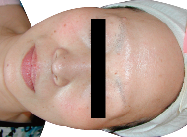 赤ら顔改善例2:After